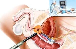 Façons de diagnostiquer la prostatite