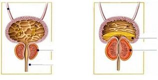 Types et formes de prostatite chez les hommes