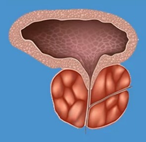 Les symptômes typiques de la prostatite