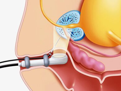 Biopsie par ponction de la prostate