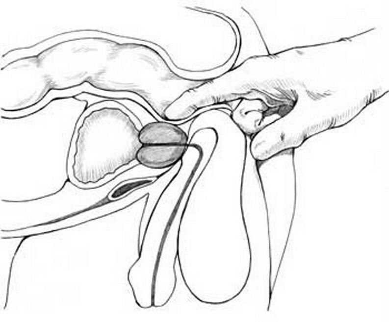 Massage de la prostate pour la prostatite chronique