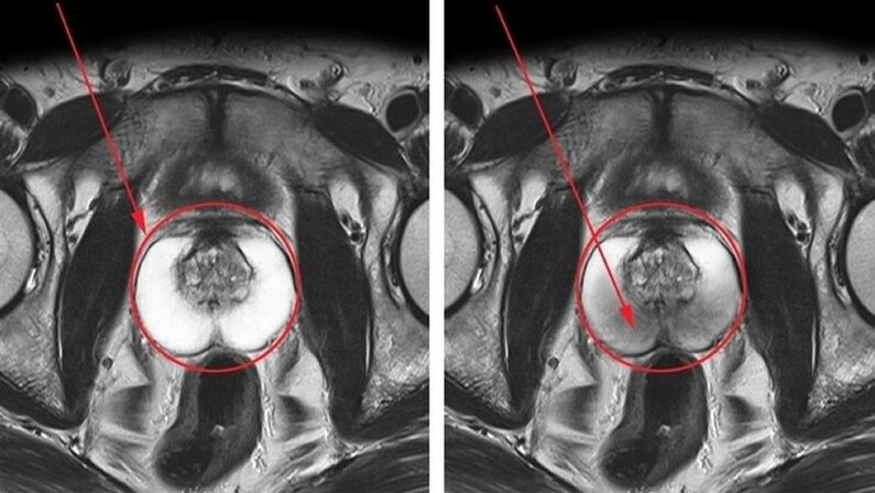 une prostate saine et enflammée avec prostatite chronique