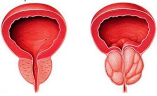 de la prostate